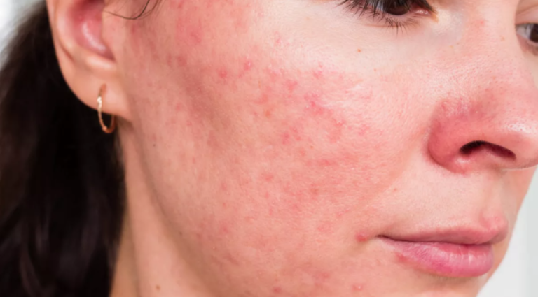 Does gut health affect skin?